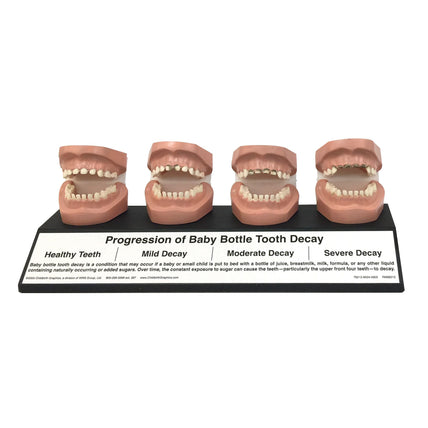 Progression Of Baby Bottle Tooth Decay Display